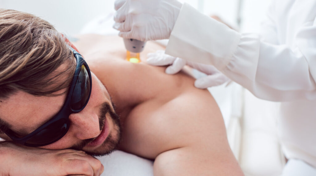 Laser hair removal on the back