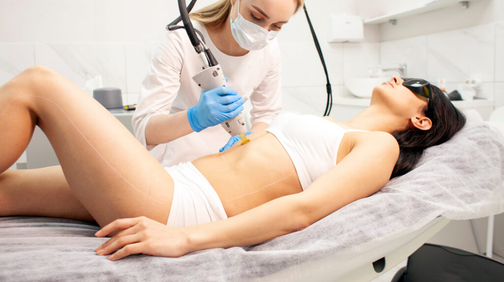 Laser hair removal on the abdomen