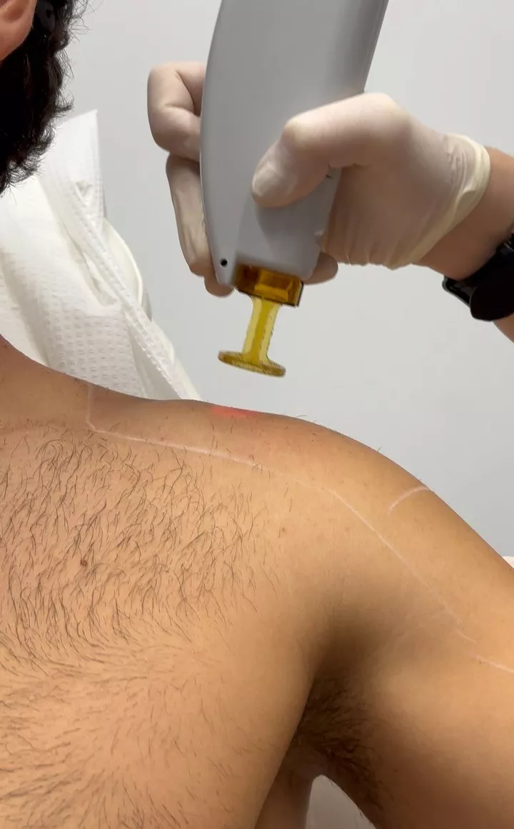 διαδικασία laser αποτρίχωσης